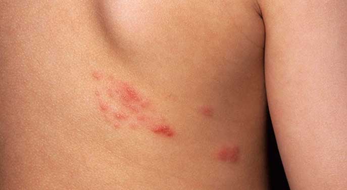 Time to start the shingles vaccination campaign
